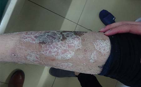 銀屑病應該怎么進行治療