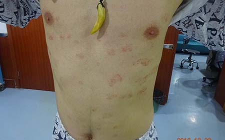 銀屑病患者應該進行護理