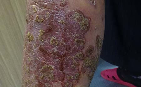 銀屑病患者應該怎么護理