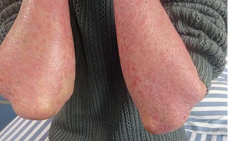 銀屑病應(yīng)該怎么進(jìn)行護(hù)理