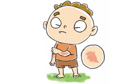 銀屑病應(yīng)該怎么進(jìn)行護(hù)理