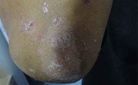 導致銀屑病的原因有什么