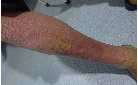 預防銀屑病的方法有什么