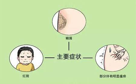 銀屑病患者應該注意什么