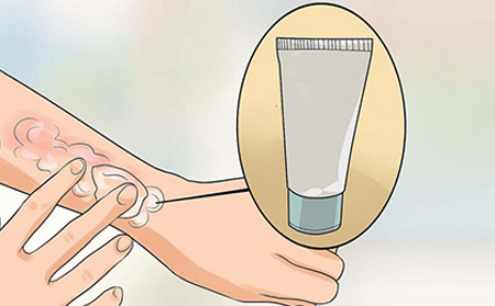 銀屑病應該怎么注意護理