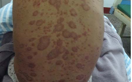 銀屑病的癥狀有什么