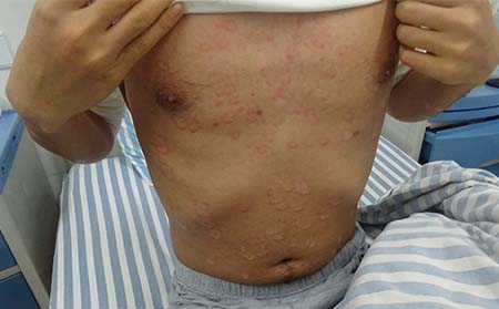 銀屑病的護理方法有什么