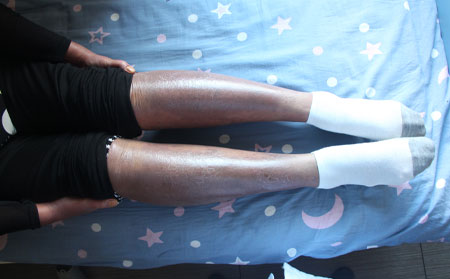 銀屑病應該怎么護理