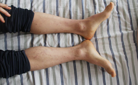 什么樣的癥狀是銀屑病