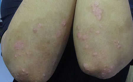 銀屑病的護理方法有什么