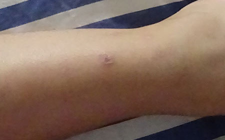 銀屑病的治療方法