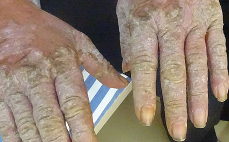 銀屑病患者應該怎么進行護理