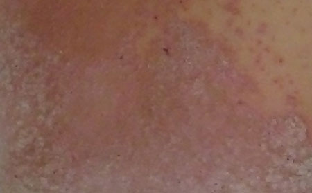 銀屑病的護理方法有什么