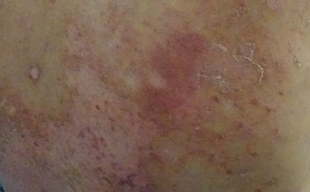 銀屑病患者應(yīng)該怎么預(yù)防