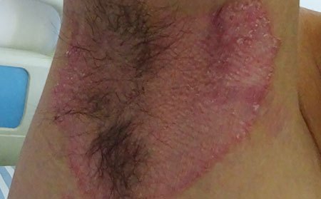 銀屑病的治療方法有什么