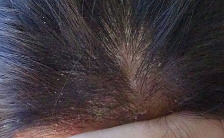 銀屑病需要怎么護理