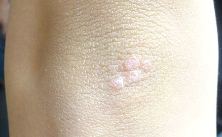 銀屑病患者怎么注意飲食