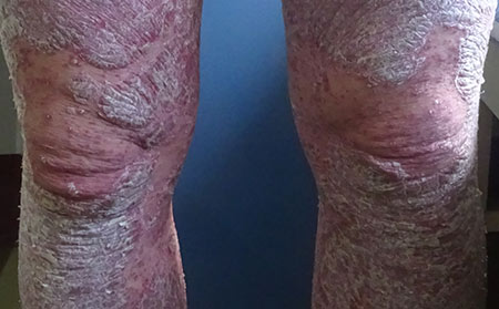 銀屑病為什么會發生