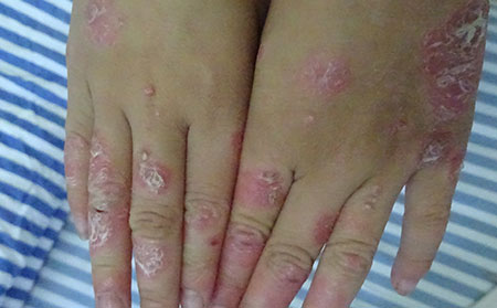 銀屑病應該怎么進行護理