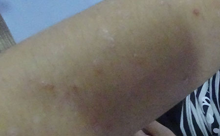 銀屑病怎么預防比較不錯