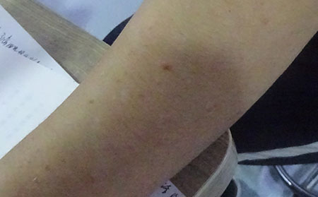 銀屑病應該怎么進行治療