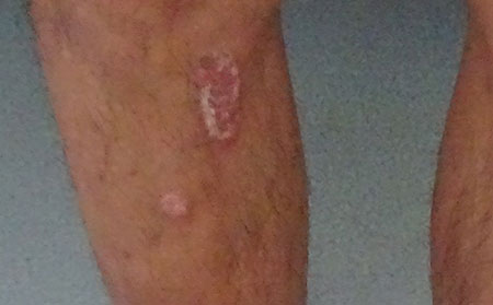 銀屑病患者應該怎么注意飲食