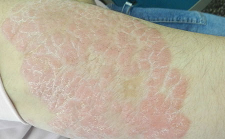 銀屑病怎么進行心理治療