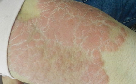 銀屑病應(yīng)該怎么進行治療