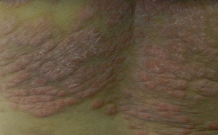 銀屑病怎么護理比較不錯