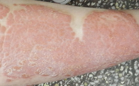 銀屑病怎么護理比較不錯