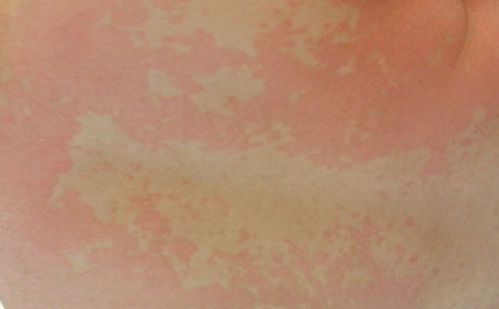 銀屑病應該怎么進行護理