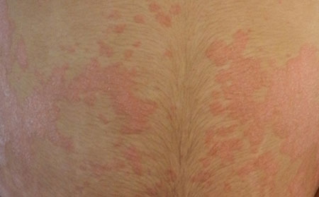 銀屑病應(yīng)該怎么進(jìn)行護(hù)理