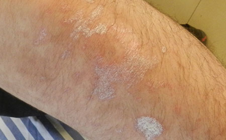 導致銀屑病的原因