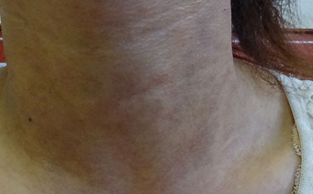 銀屑病的治療方法有什么