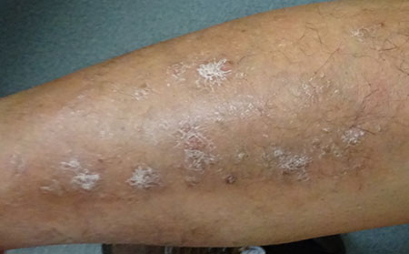 導致銀屑病的原因有什么