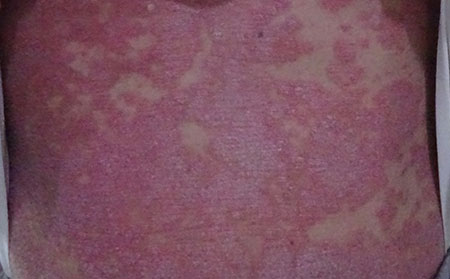 銀屑病應該怎么進行護理