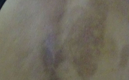 銀屑病應該怎么護理