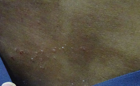 治療銀屑病需要多少錢