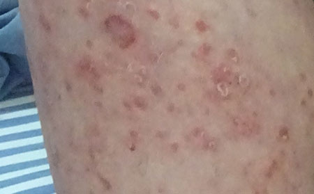 銀屑病的護(hù)理方法有什么