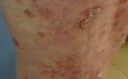 銀屑病的預防方法有什么