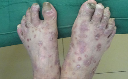 銀屑病怎么注意飲食