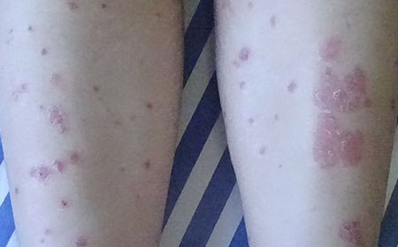 銀屑病患者該怎么調(diào)節(jié)自己的心理