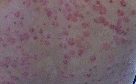 銀屑病治療醫(yī)院是哪家