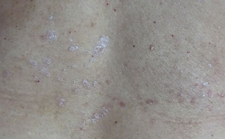 治療銀屑病需要多少錢