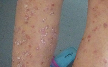 銀屑病應該怎么注意飲食