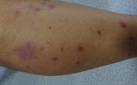 導致銀屑病的原因有什么