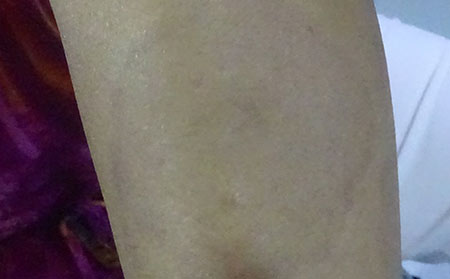 銀屑病為什么難以治療