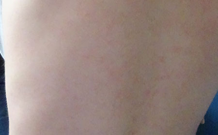 銀屑病的護理方法有什么