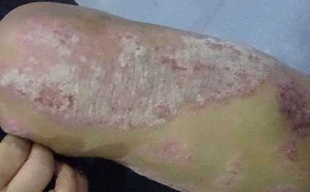 銀屑病治療需要花多少錢