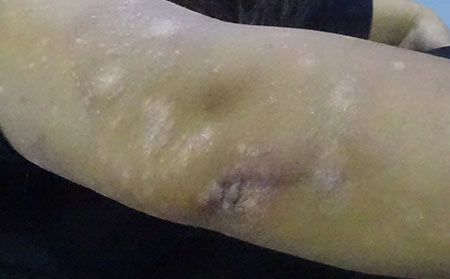 銀屑病應該怎么護理